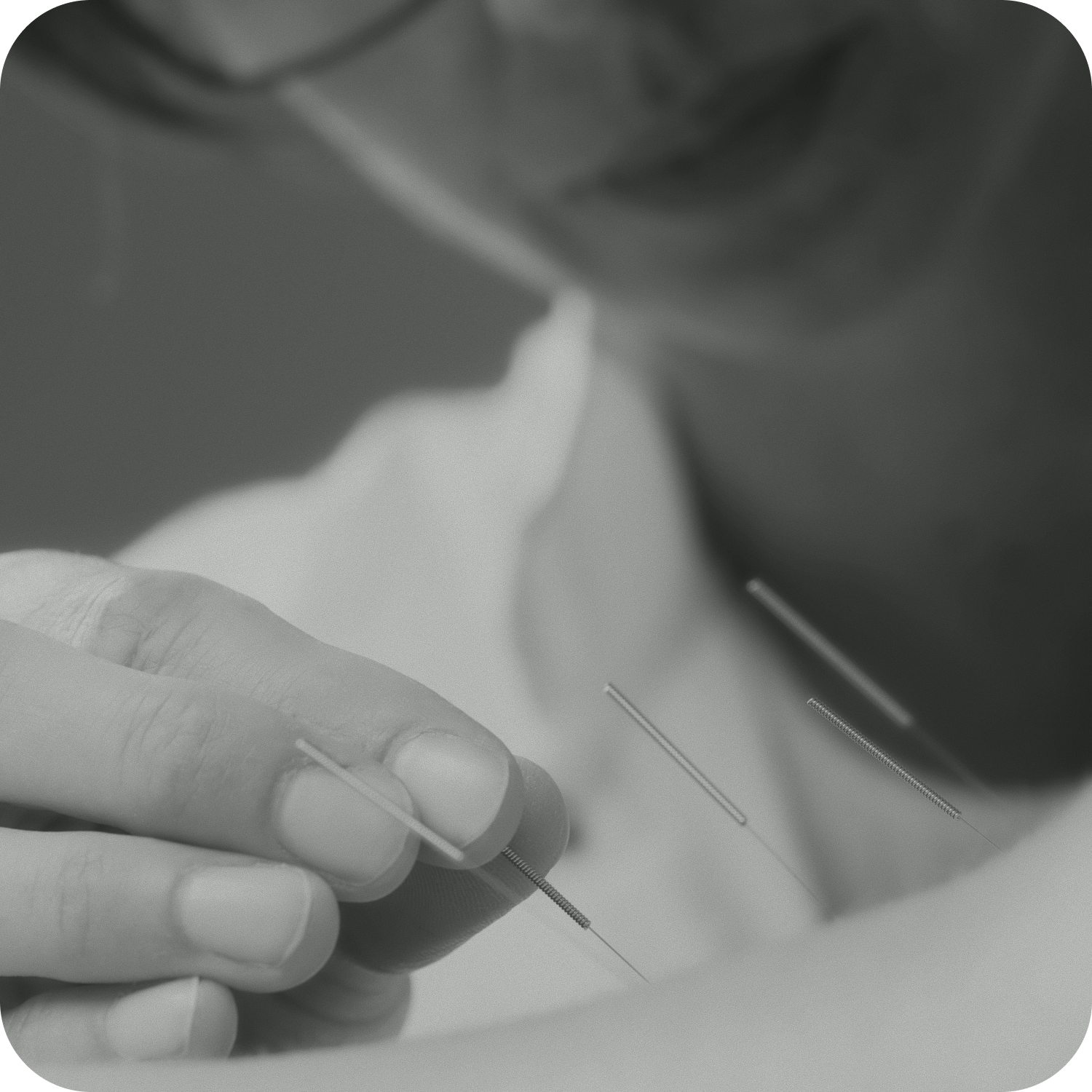 Acupuncture