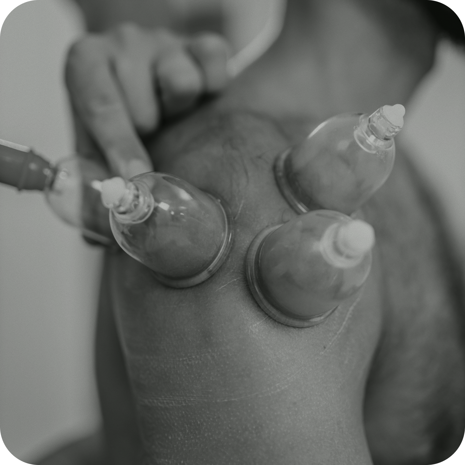 Cupping